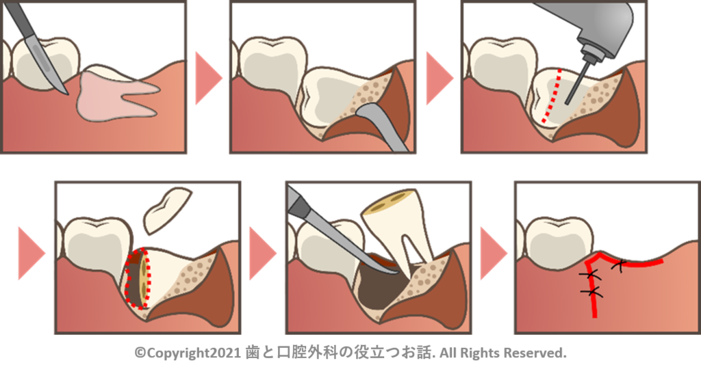 親知らず抜歯