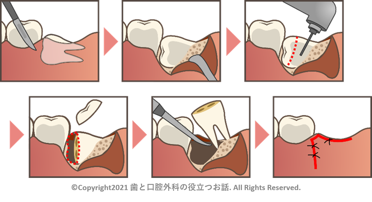 親知らず 下 の 歯 横向き