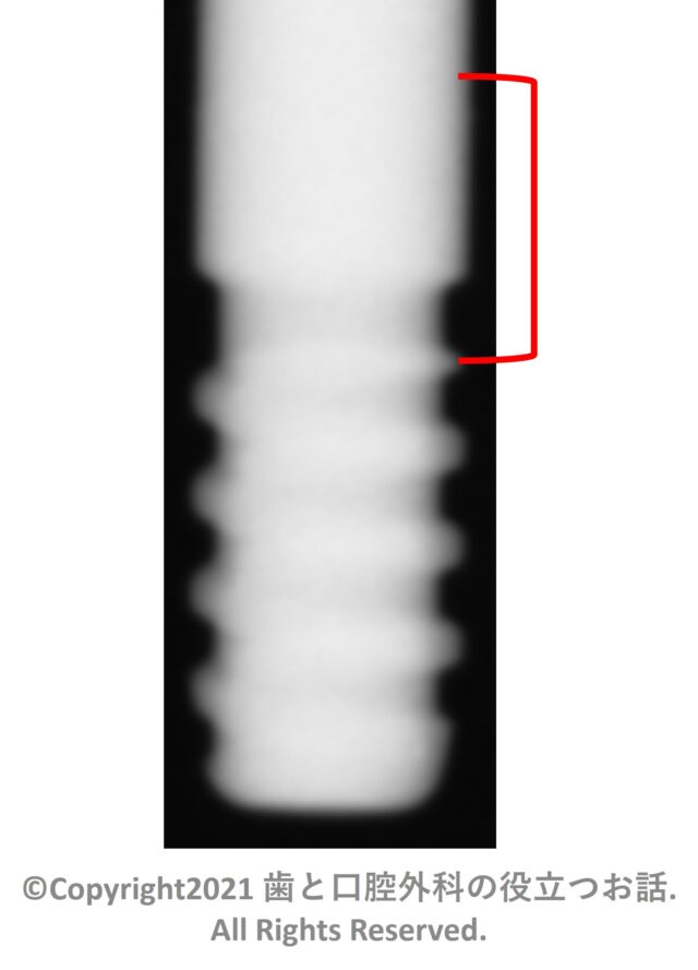 AQB Implant one-piece