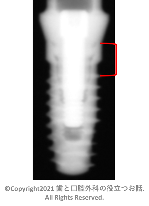 T3 Non-Platform Tapered Implant