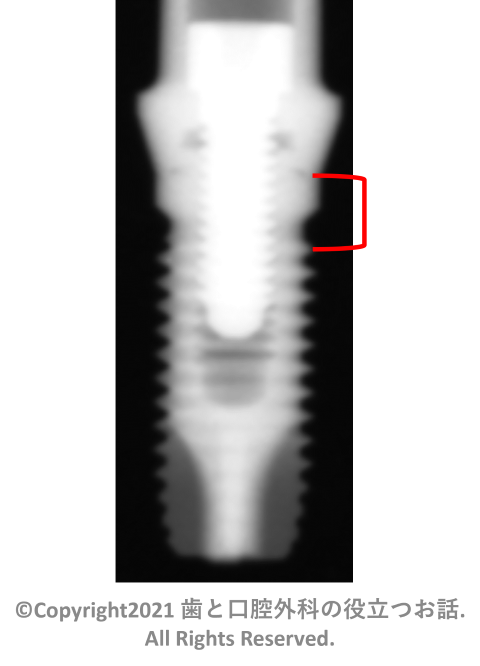 T3 Osseotite External Parallel Walled Implant