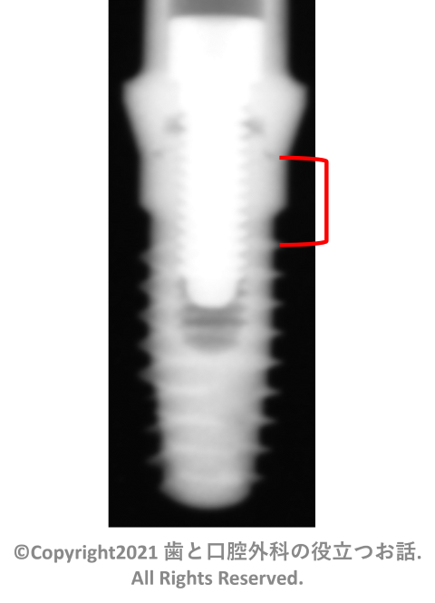 T3 Osseotite External Tapered Implant