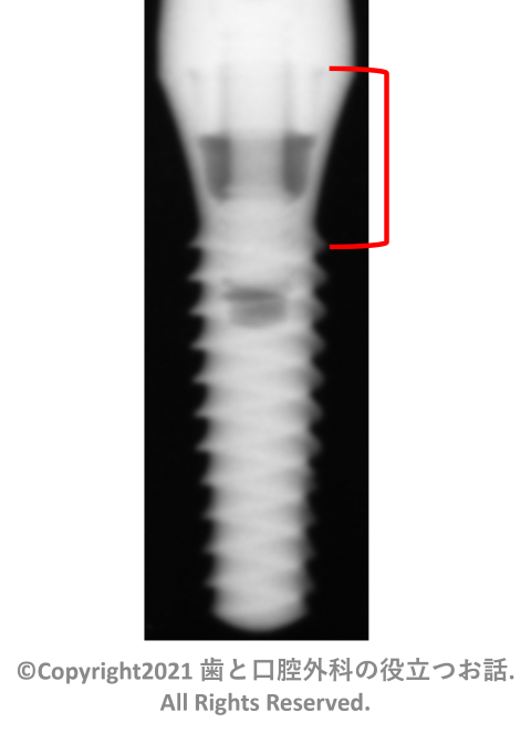 Swiss Plus Implant Tapered