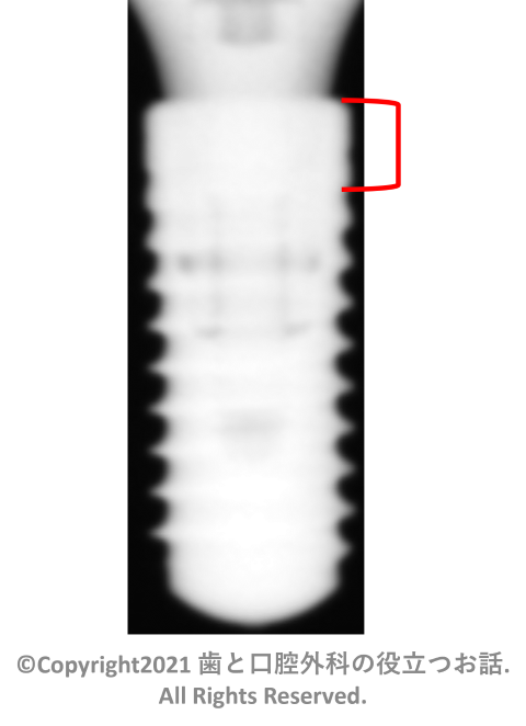 Straumann Bone Level Implant