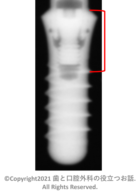 Straumann Tissue Level Implant