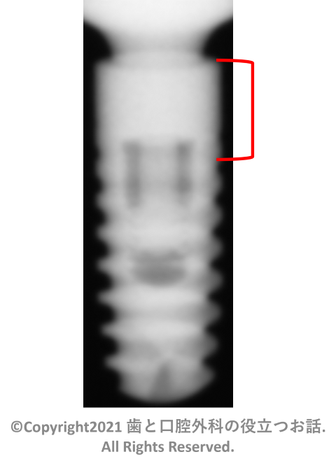 Ankylos C/X Implant