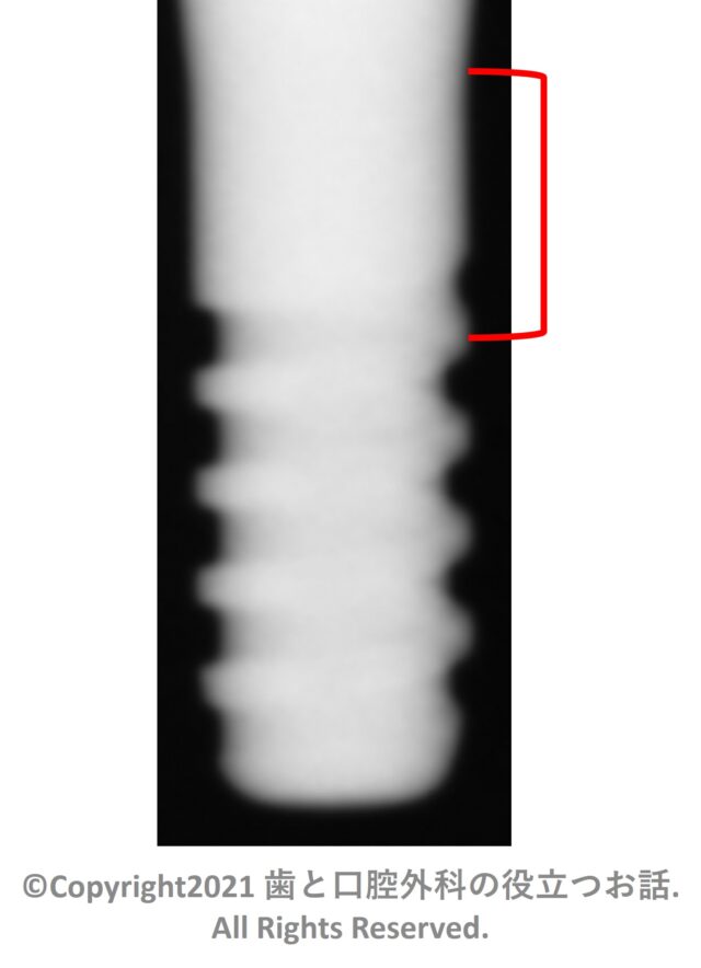 AQB Implant T type one-piece