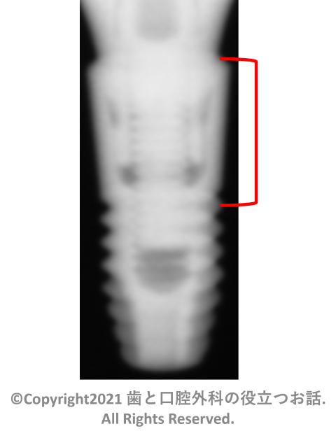 Astra Tech Implant OsseoSpeed EV Conical