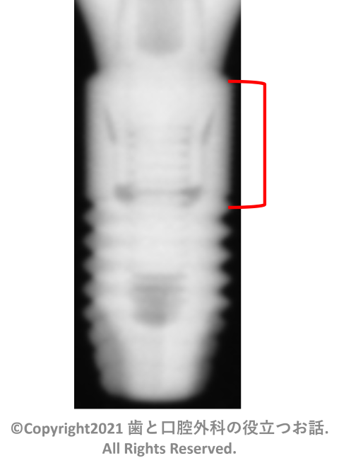 Astra Tech Implant OsseoSpeed EV Straight