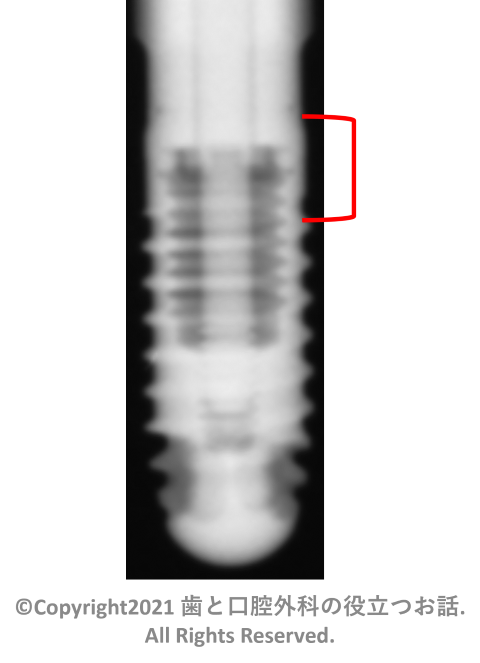 IMZ Implant TwinPlus Screw