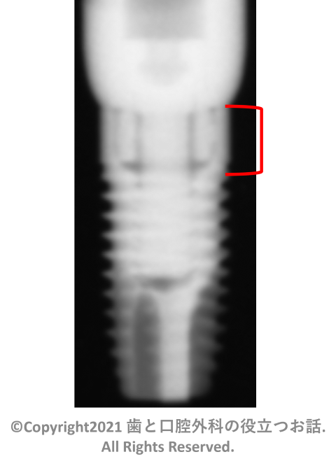 Neoss ProActive Straight implant