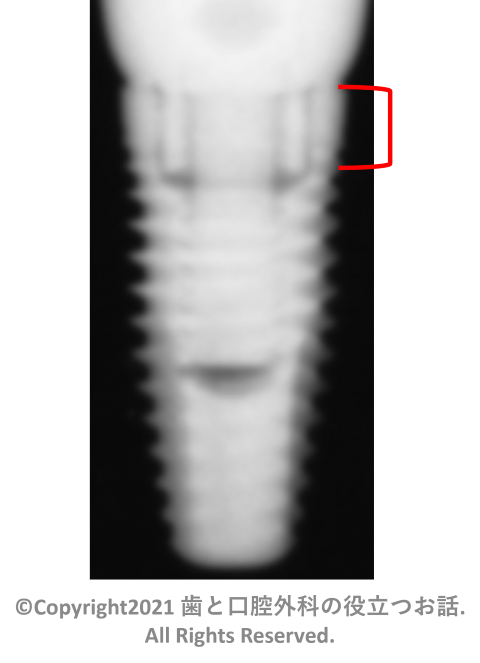 Neoss ProActive Tapered implant