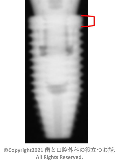 Nobel Parallel CC