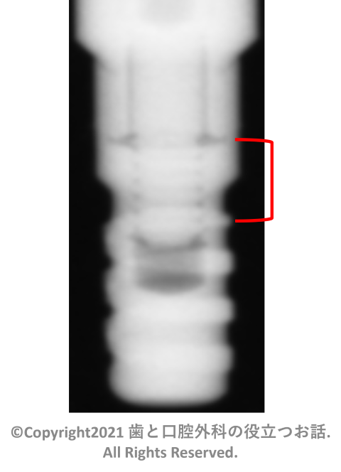 AQB Implant two-piece