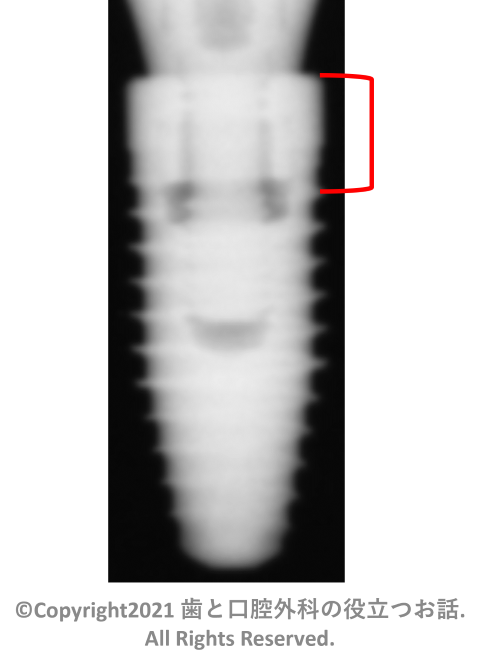 Nobel Replace Tapered CC PMC