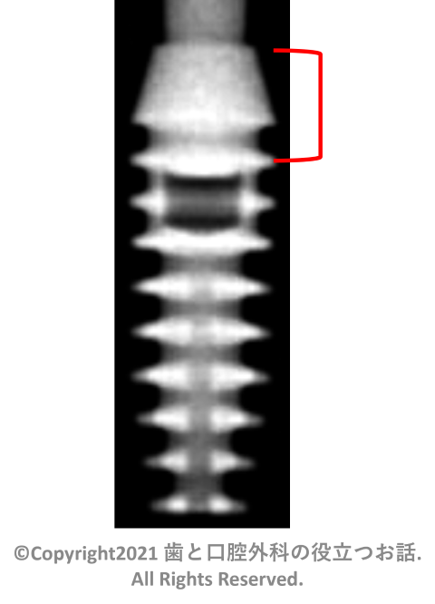 Bicon Integra CP Implant