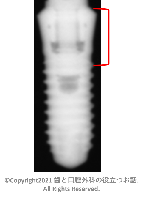 Mytis Arrow Implant B-type