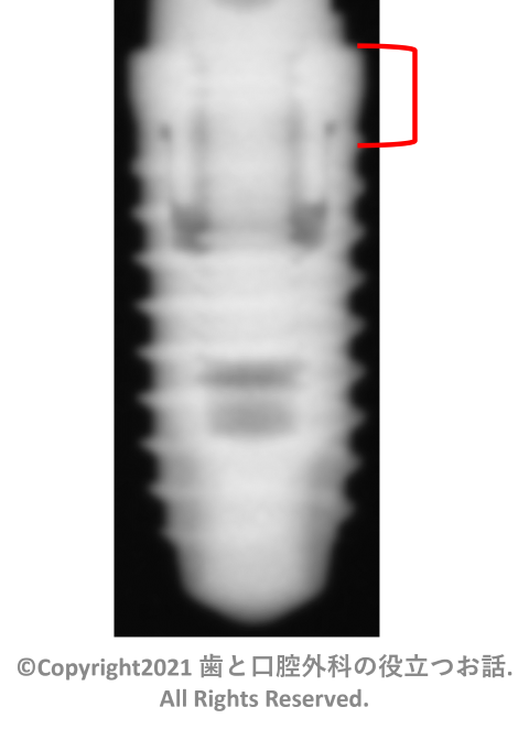 Mytis Arrow Implant C-type