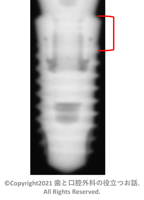 Mytis Arrow Implant E-type