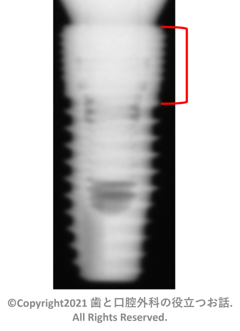 Dentium Implantium