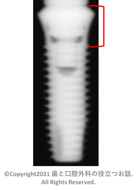 Dentium SimpleLineⅡ