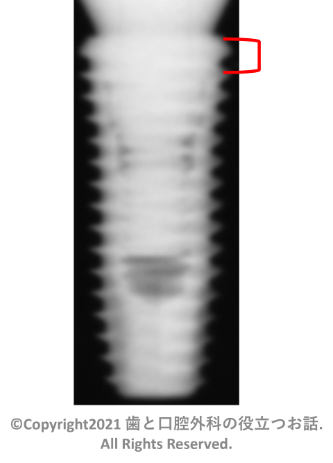 Dentium SuperLine