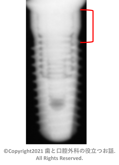 CAMLOG SCREW implant