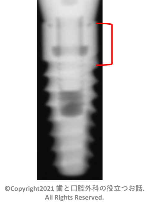 BioHorizons Internal Taperd implant