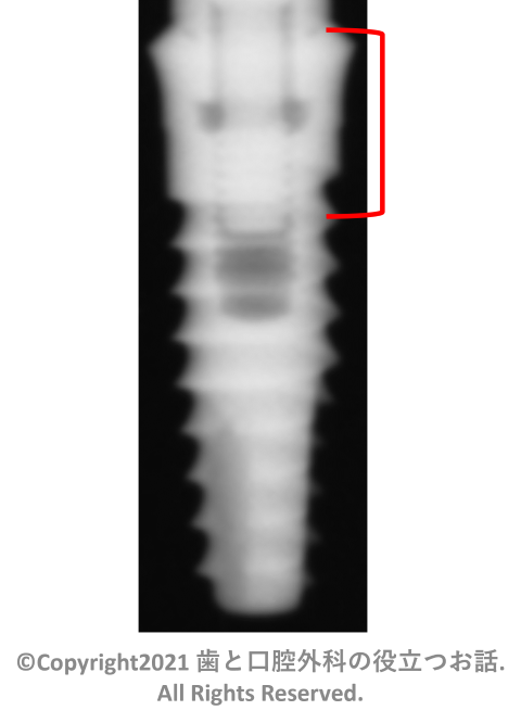 BioHorizons Tissue Level Implant