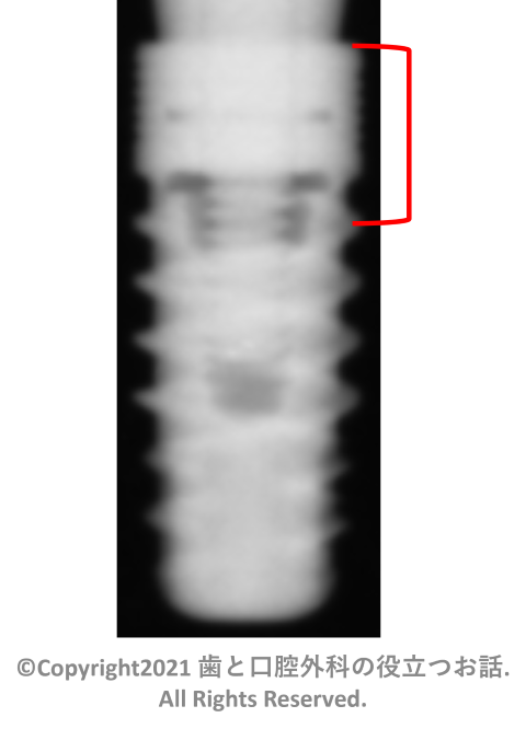 Aadva Standard Implant Regular