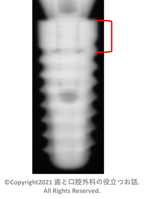 PLATON Eight-Lobe Pro implant