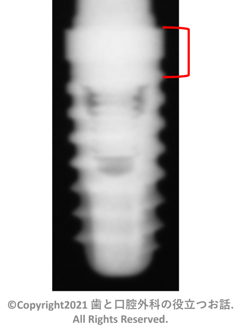 PLATON TypeⅣ implant