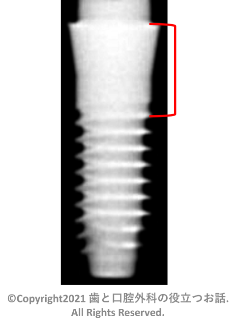 u-one HA Implant one-piece TL