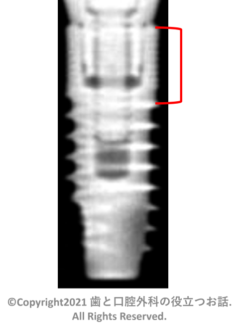 u-one HA Implant two-piece