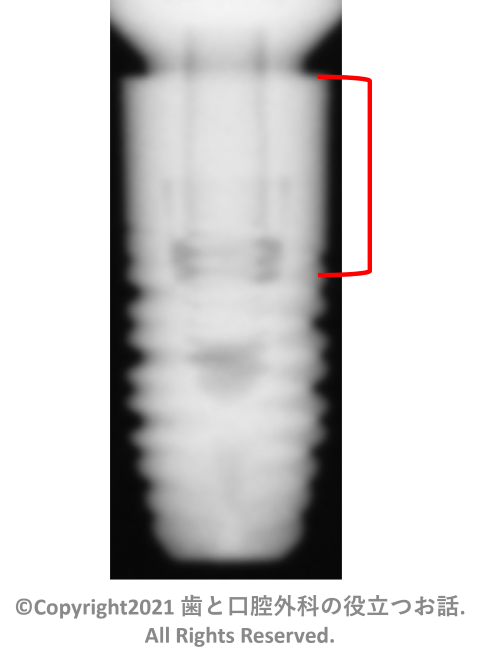 Shofu Biofix implant