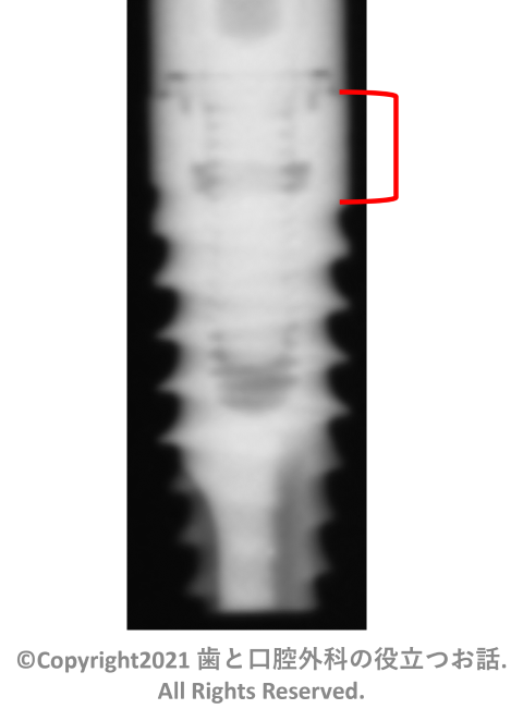 Sweden&Martina Premium Straight implant