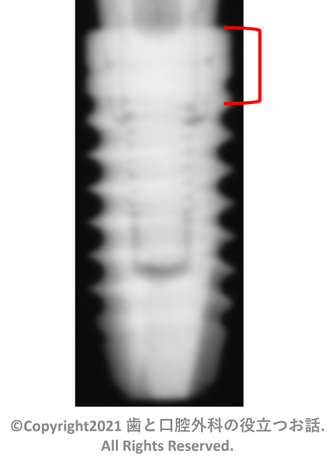 IAT Bone Level implant