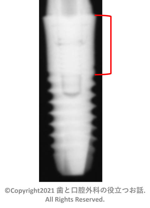 IAT Tissue Level implant