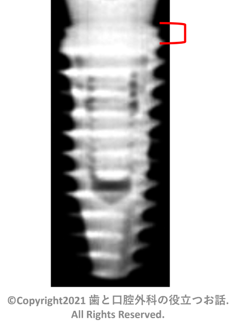 IS-II active Implant Regular