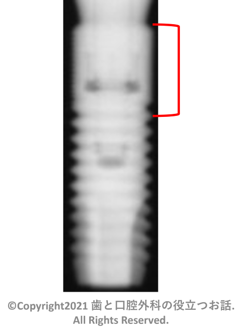 Astra Tech Implant System OsseoSpeed