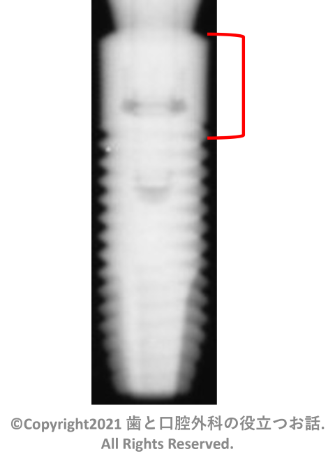 Astra Tech Implant System OsseoSpeed TX