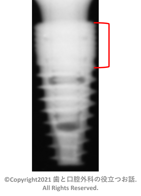 Alphatite Implant TF