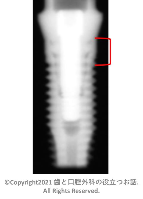 T3 Non-Platform Parallel Walled Implant