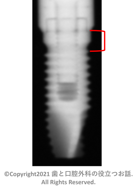 spline MP-1