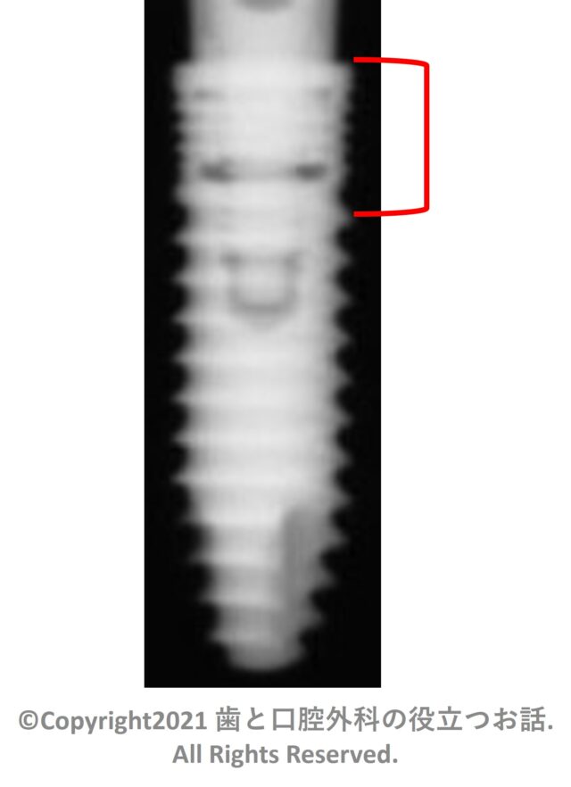 FINESIA Bone Level Tapered type Implant