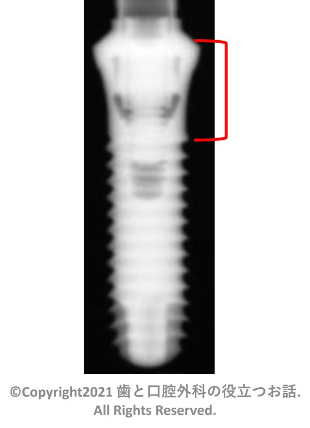 FINESIA Tissue Level Straight type Implant