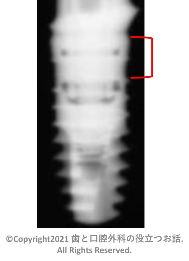 Xive S Implant