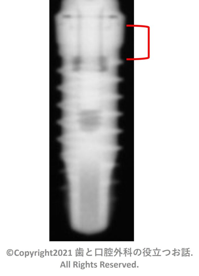 SPI ELEMENT Implant