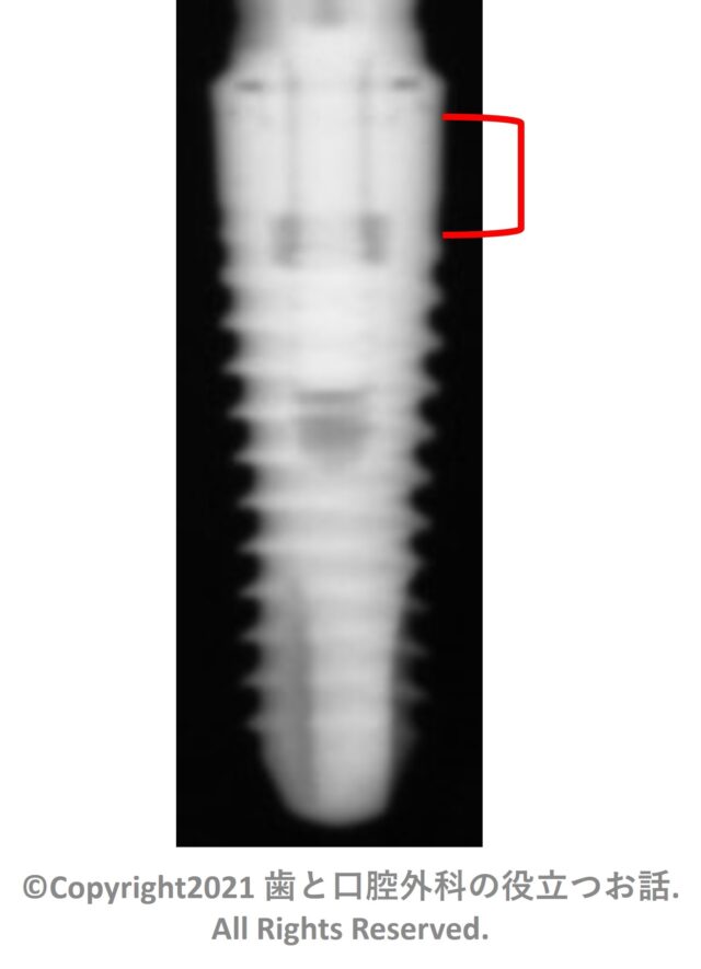 SPI CONTACT Implant