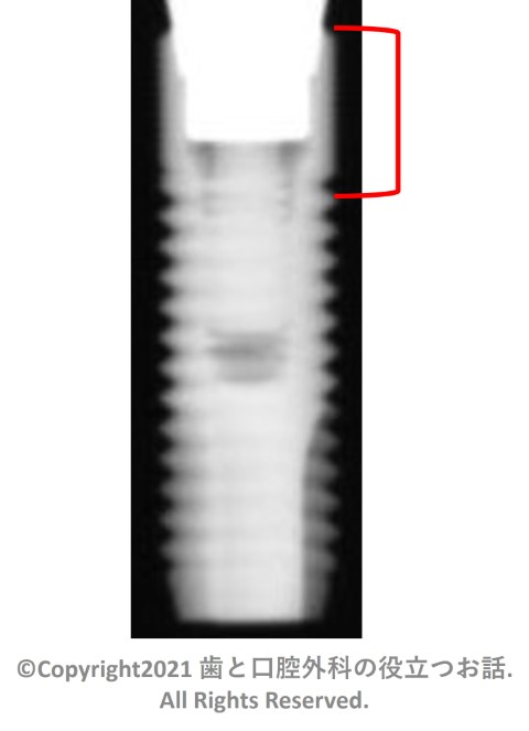 Astra Tech Microthread Implant